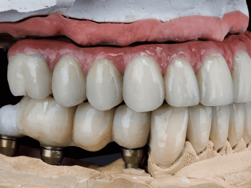 Common Problems with Dental Bridges